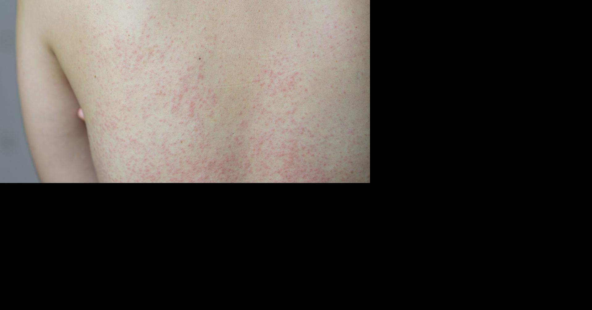 Covering Your Health: Louisiana reports first measles case of 2026