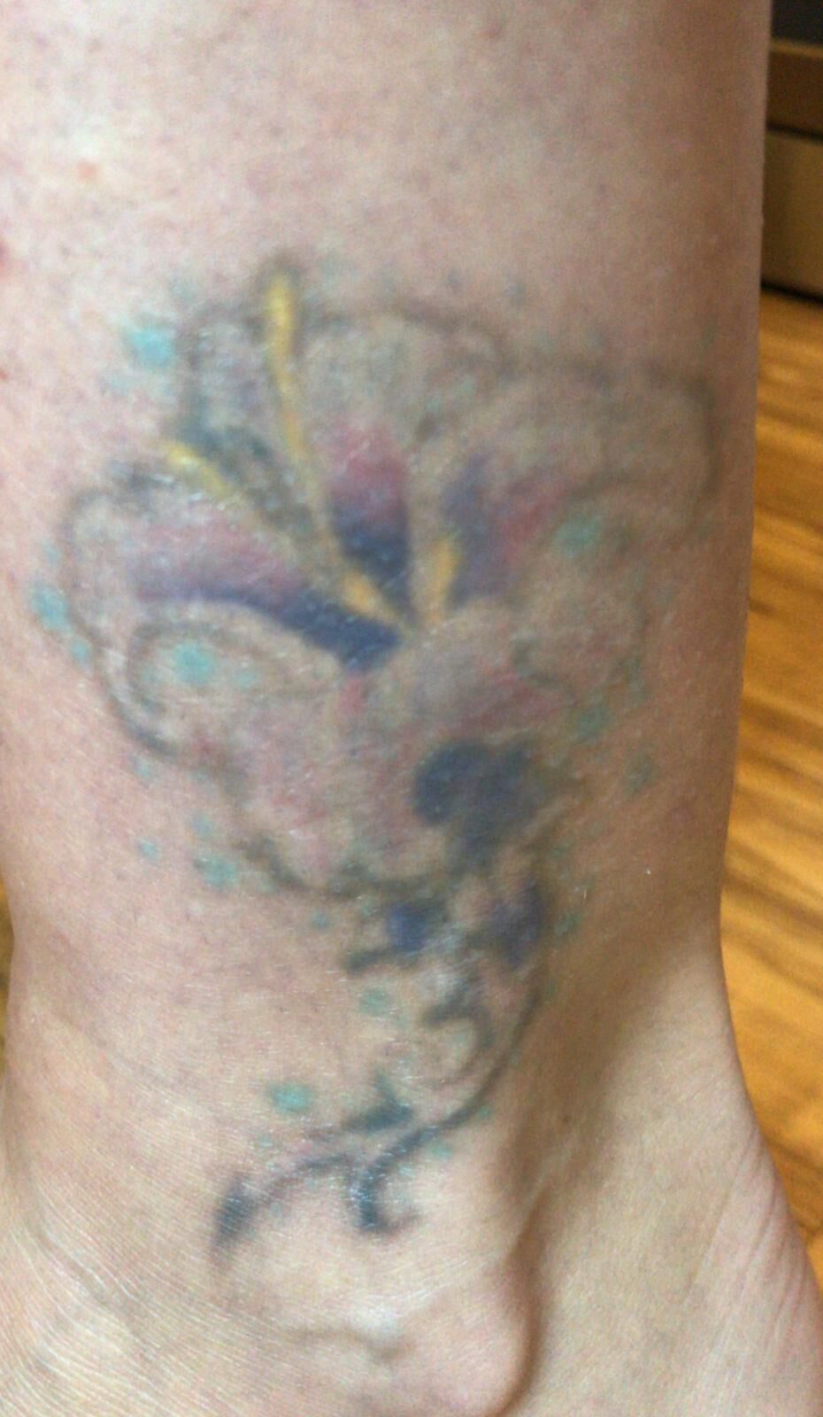 BEFORE  AFTER LASER TATTOO REMOVAL  7049A S Desert Blvd El Paso Texas   Tattoo Removal  Phone Number  Yelp