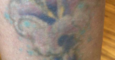 Laser tattoo removal business sees increase since COVID-19 | Local News |  