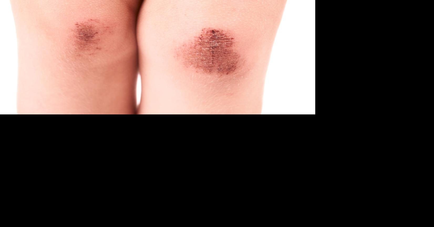 Treating skin abrasions known as ‘raspberries’ Health