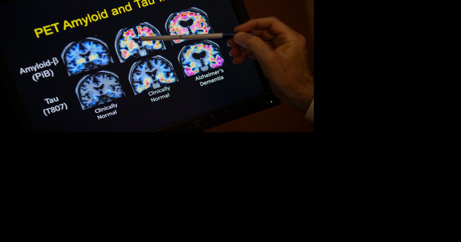 Be Well-Alzheimer's-Blood Tests