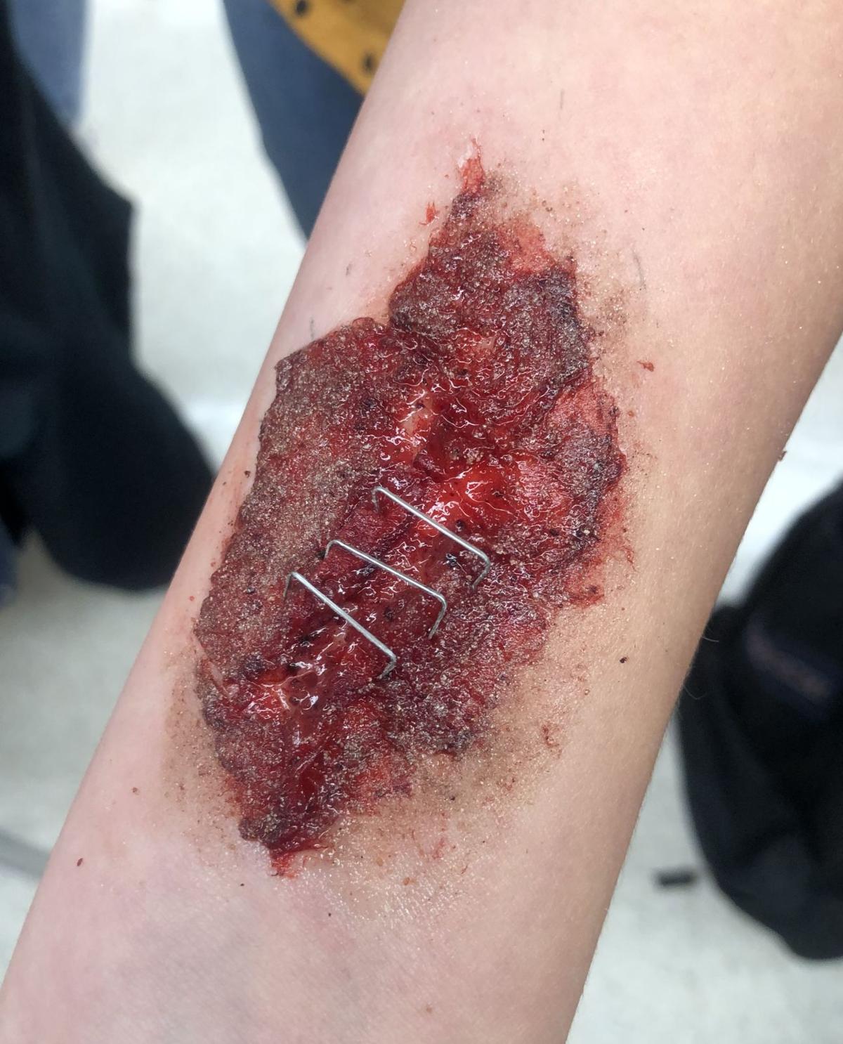 Wounds Wounds