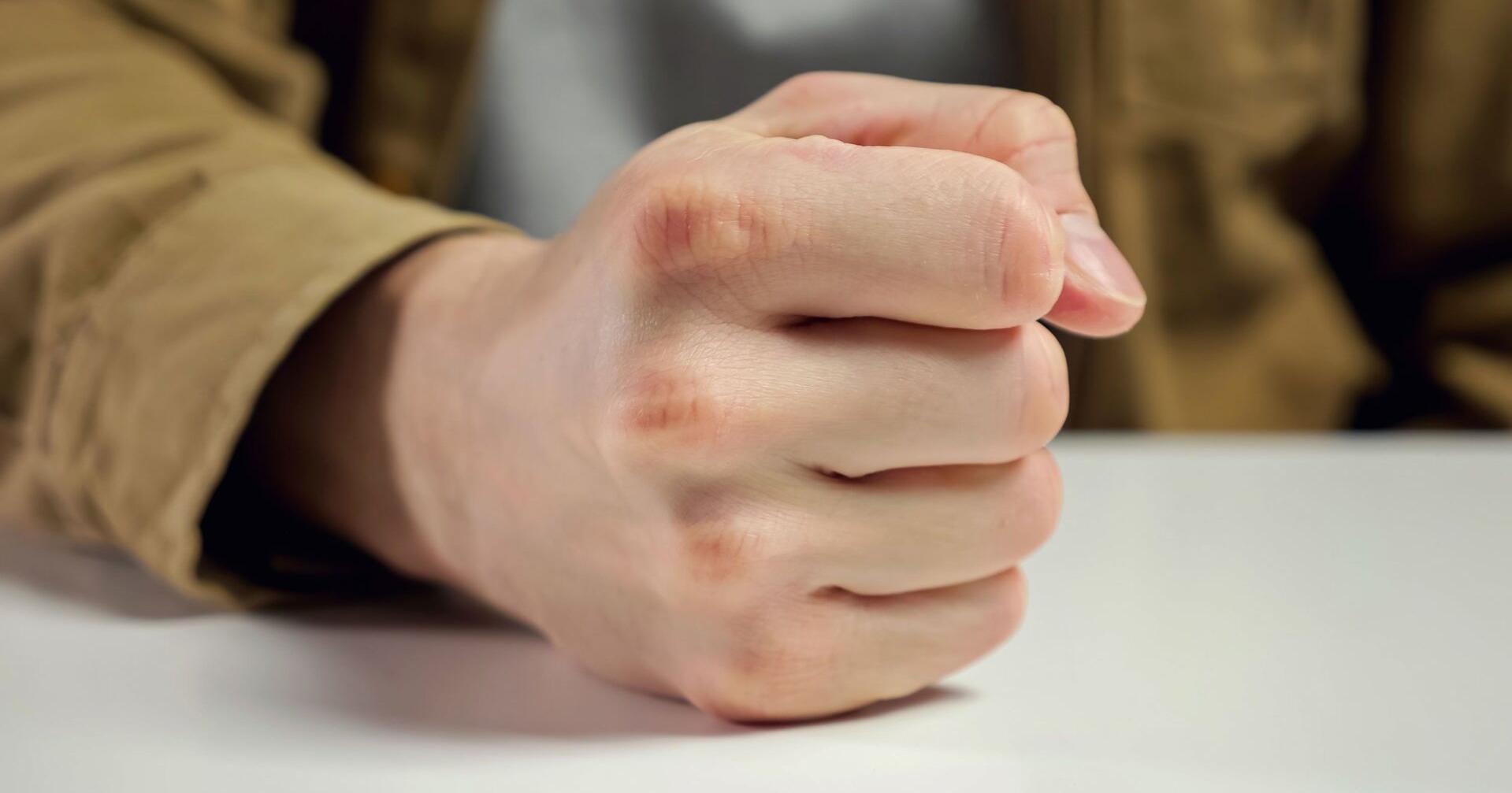 Anger can harm your blood vessel function, study shows - Vimarsana News