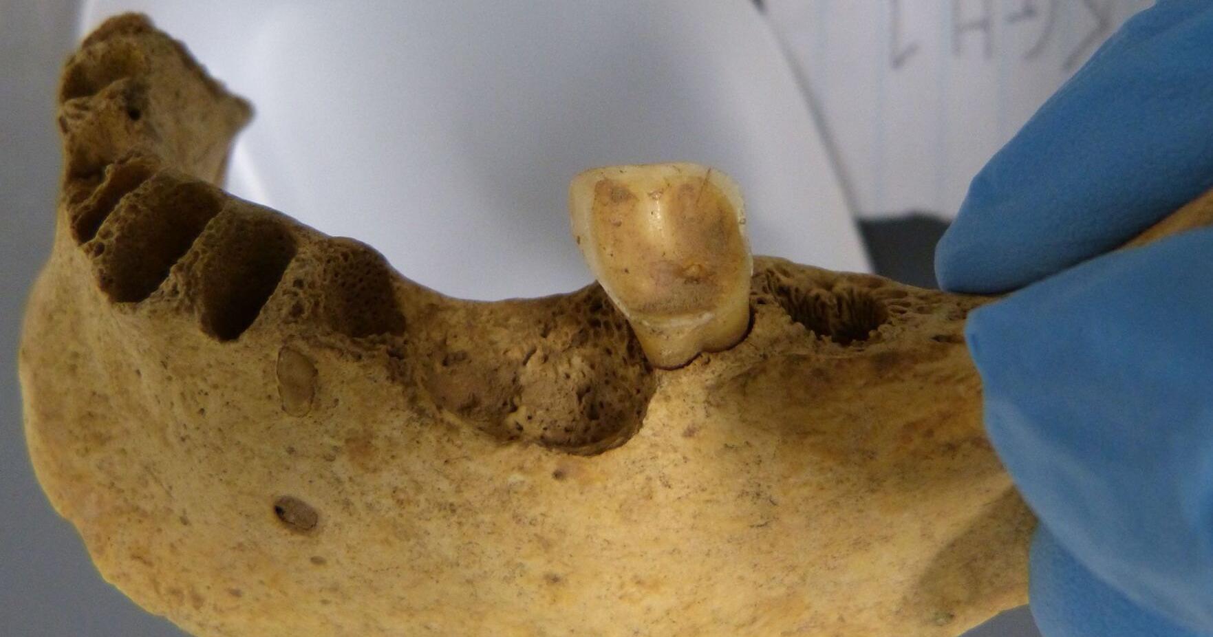 Ancient teeth rarely have a cavity-causing bacteria commonly seen today. A new study reveals why - Vimarsana News