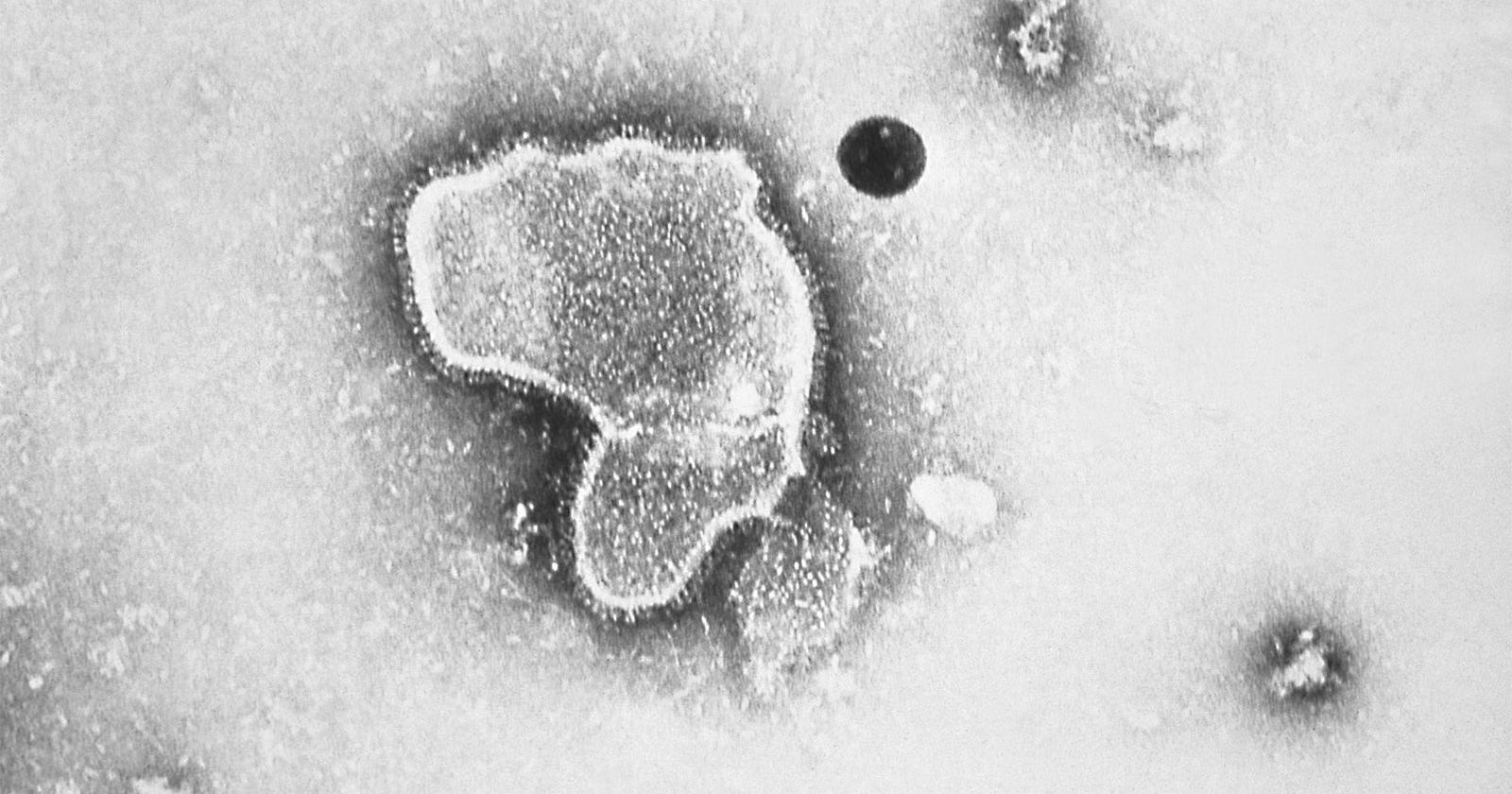 CDC warns that RSV cases may be starting to rise - Vimarsana News