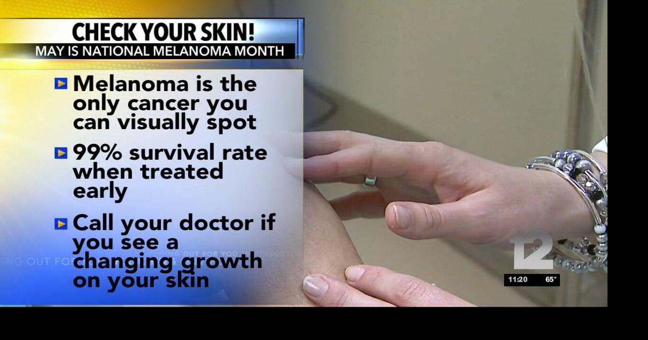 OHA says to check your skin for melanoma | Video | kdrv.com
