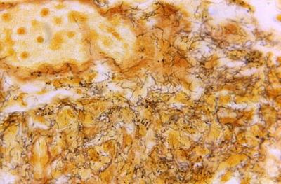 Montreal network to tackle 'explosion' in infections such as syphilis with new trials