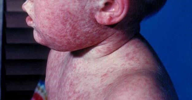 25 confirmed cases of measles in Kentucky