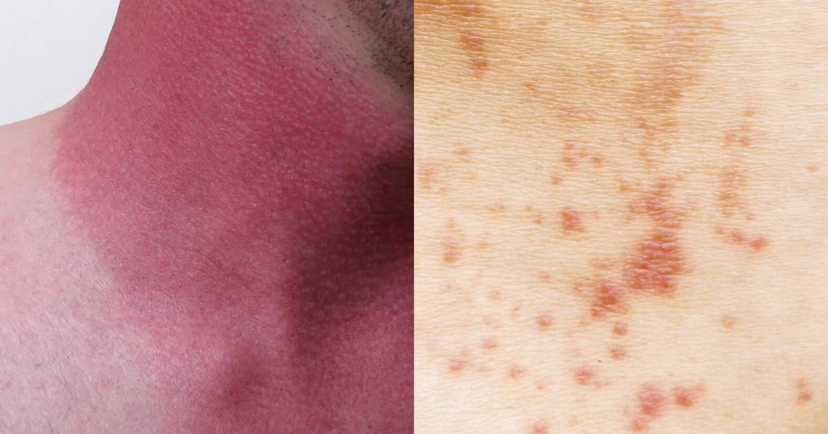 Summer hazards: From heat rash to heat stroke | Columns | keysnews.com