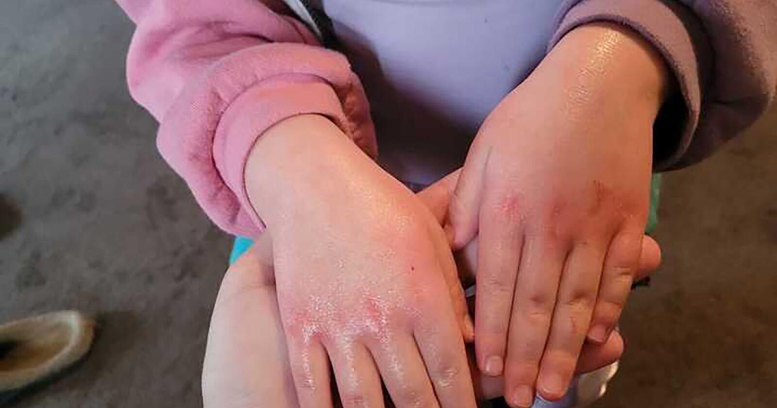 As reports of health problems near a toxic train wreck pile up, Ohio sets up a clinic while federal help gets into gear - Vimarsana News