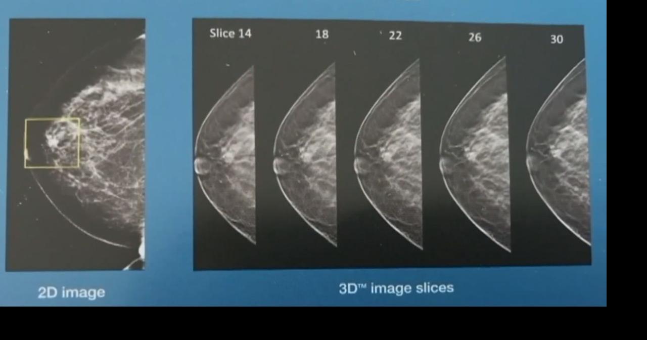 Doctor encourages mammograms after screenings drop during pandemic