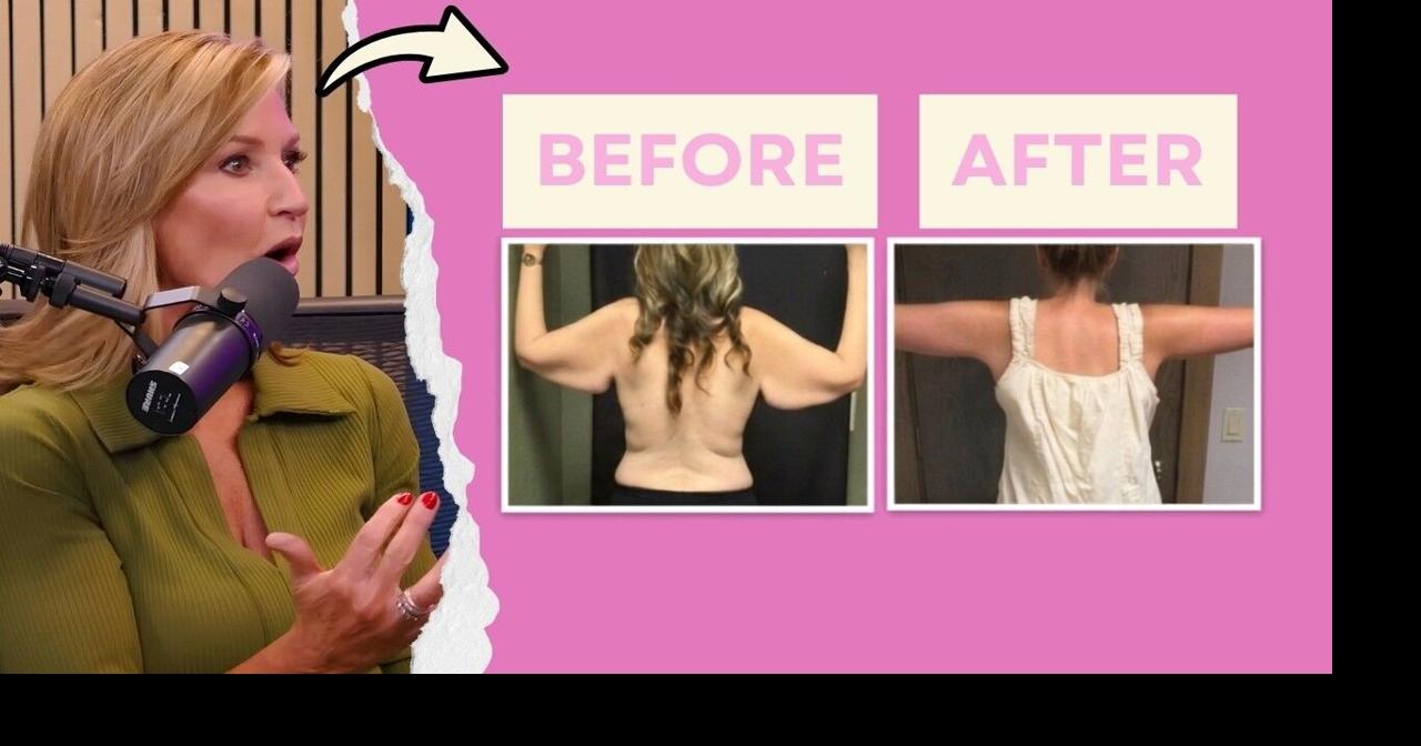 how to avoid loose skin on glp 1 Noticing after GLP-1 weight loss? You're not alone. 👀 When the weight comes off, skin doesn't always keep up — but that doesn't mean you're stuck with it. At California Loose skin caused by weight-loss