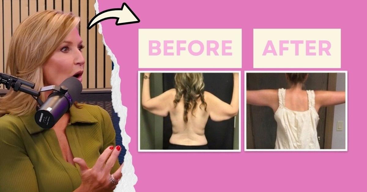 glp 1 loose skin Ozempic Weight Loss Leads to Plastic Surgery Boom to Shed Extra Lost Weight on GLP-1? This