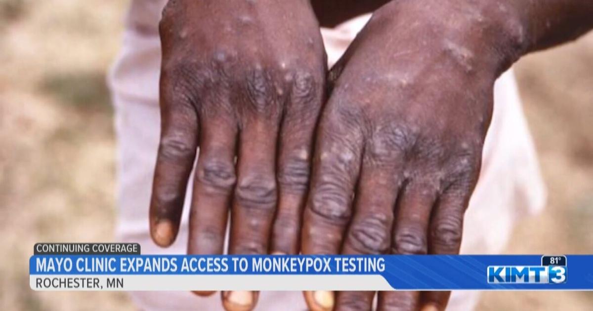 Monkeypox Testing Video Mayo Clinic expands access to monkeypox testing | Video | kimt.com