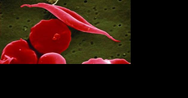 Minnesota wins $1.6 million to expand work on sickle cell disease - Vimarsana News