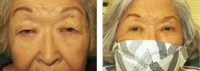 Aging Well: eye bag surgery restores greater field of vision