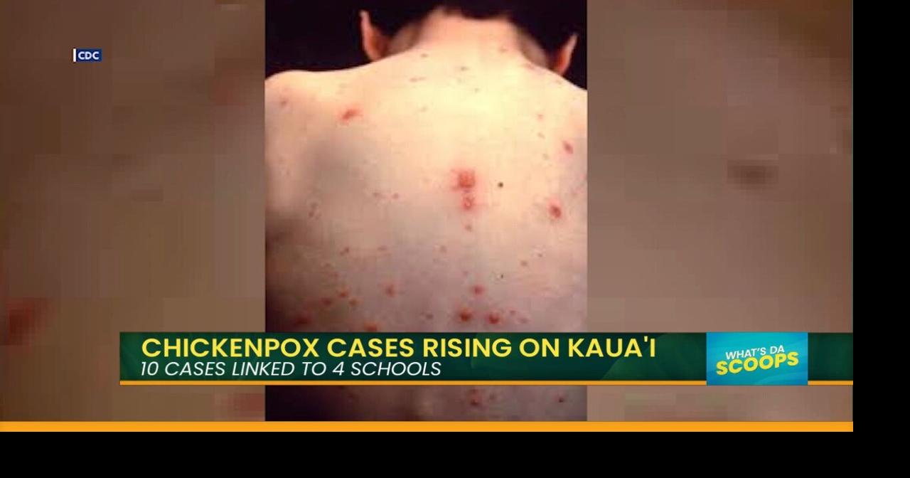 Chicken Pox is Making A Comeback On Kauaʻi | Island Life Live | kitv.com