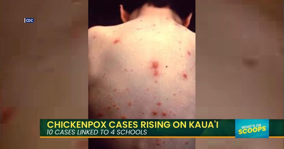 Recent Chickenpox Chicken Pox is Making A Comeback On Kauaʻi | Island Life Live | kitv.com
