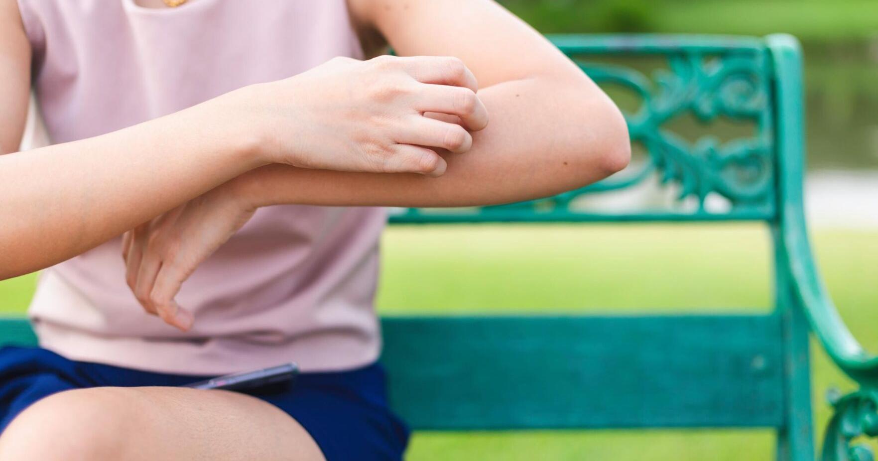What makes mosquito bites itch and what to do about it - Vimarsana News