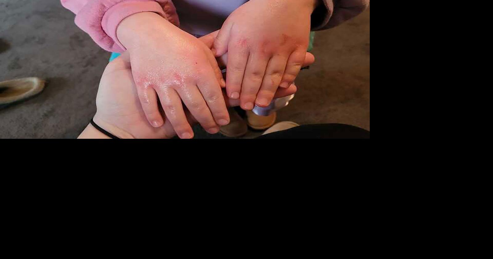 East Palestine residents worry rashes, headaches and other symptoms may ...