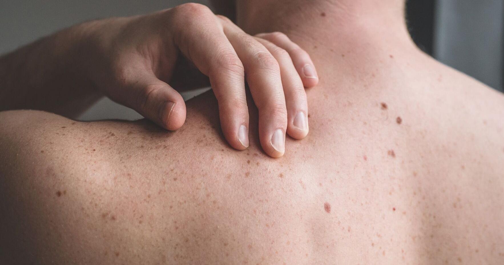 The sun's out, so you need to think about prevention of this type of cancer | National - Vimarsana News