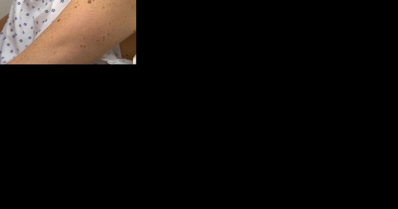 Skin cancer cases up 14% in Hawaii, according to new study - Vimarsana News