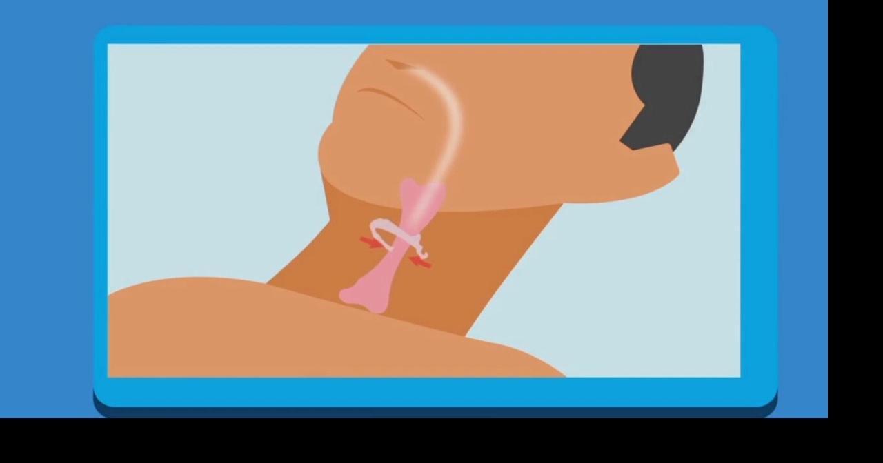 Freeman Hospital showcases new sleep apnea treatment “Airlift” Health