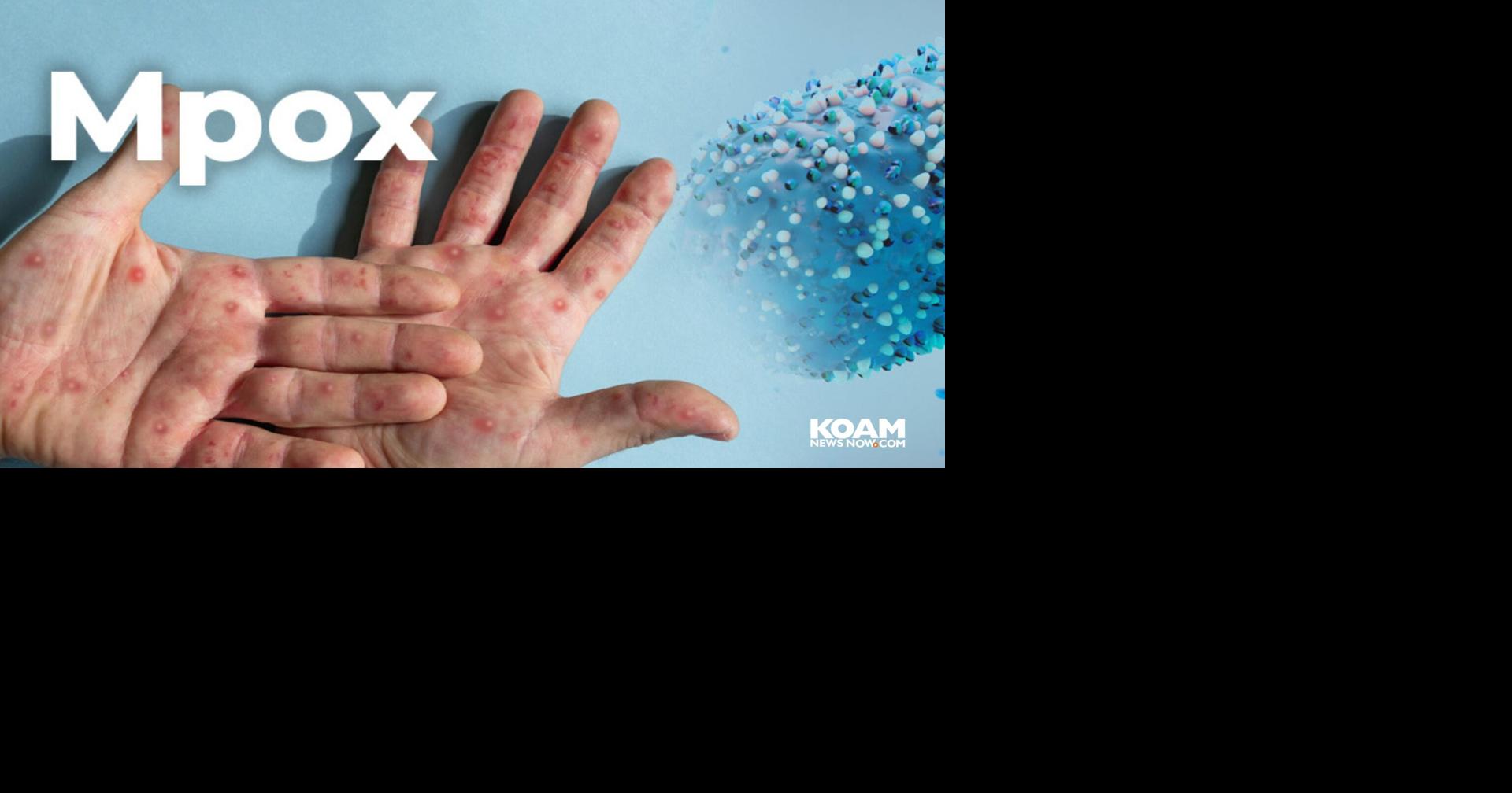 Missouri reports two cases of clade I mpox infections this week