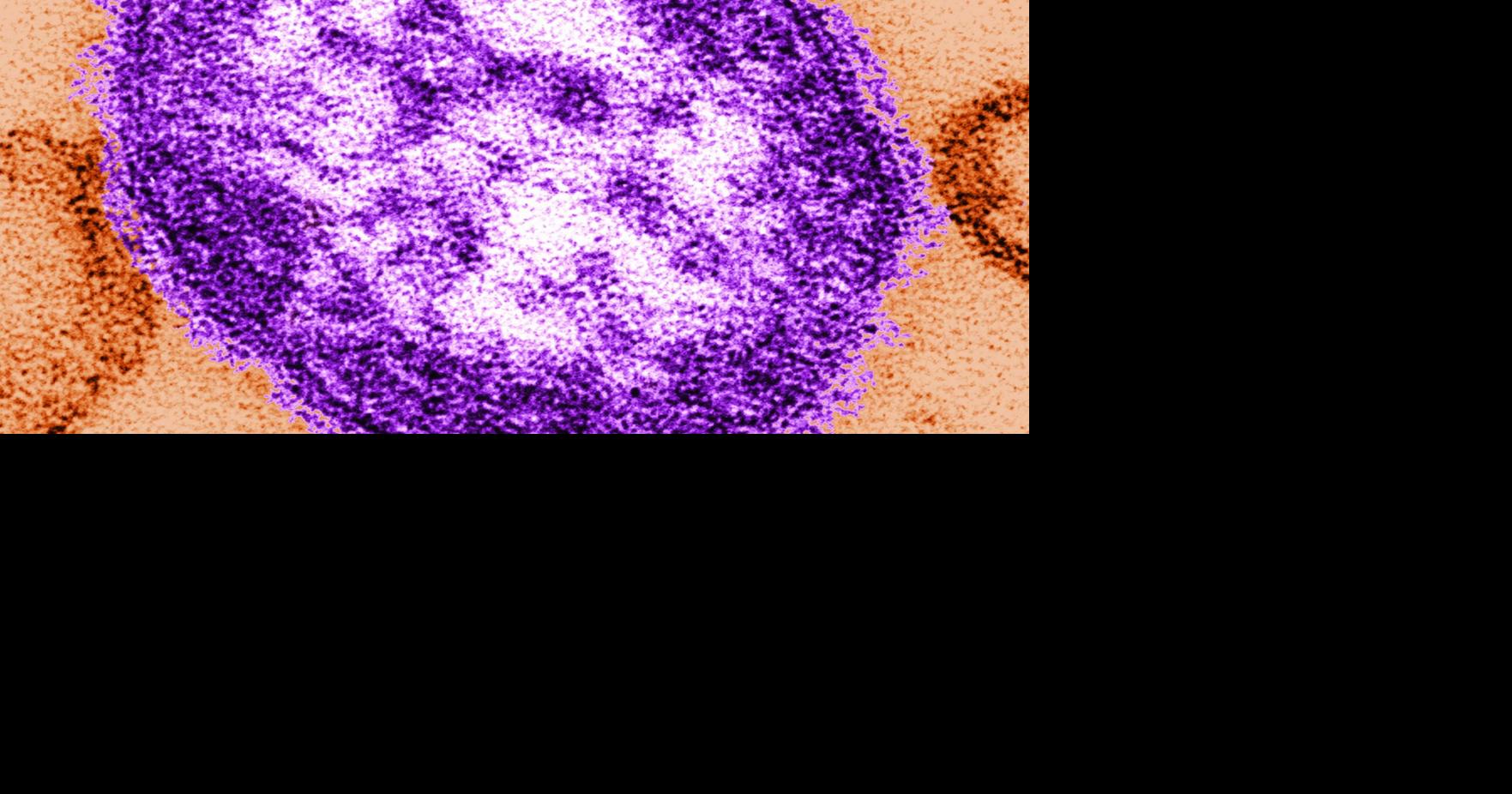 Adult woman dies of measles complications in growing Pennsylvania outbreak