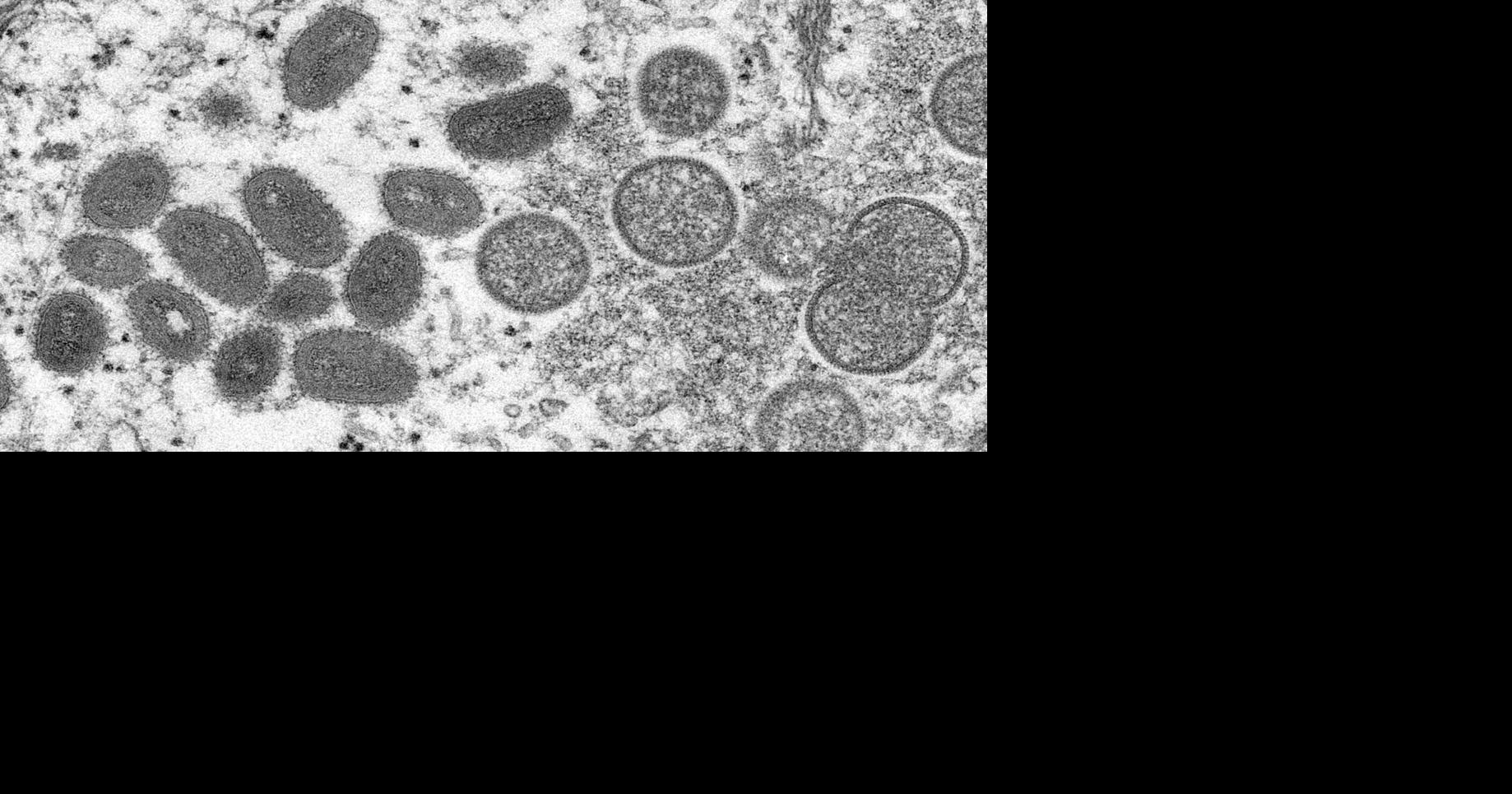 Missouri confirms first two cases of clade I mpox in state