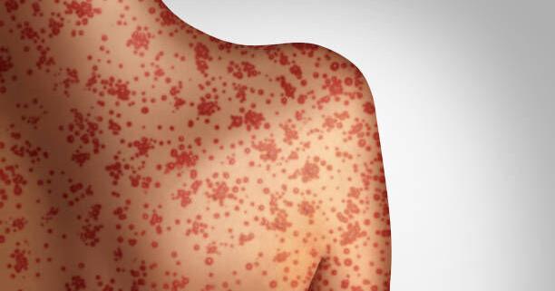 Health Officials Reported the first Eastern Idaho Measles Case this Year