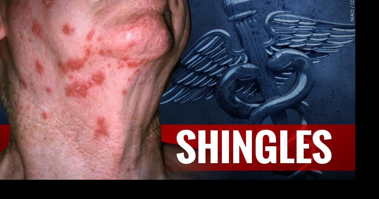Shingles Vaccines Are Available Through the Health Department