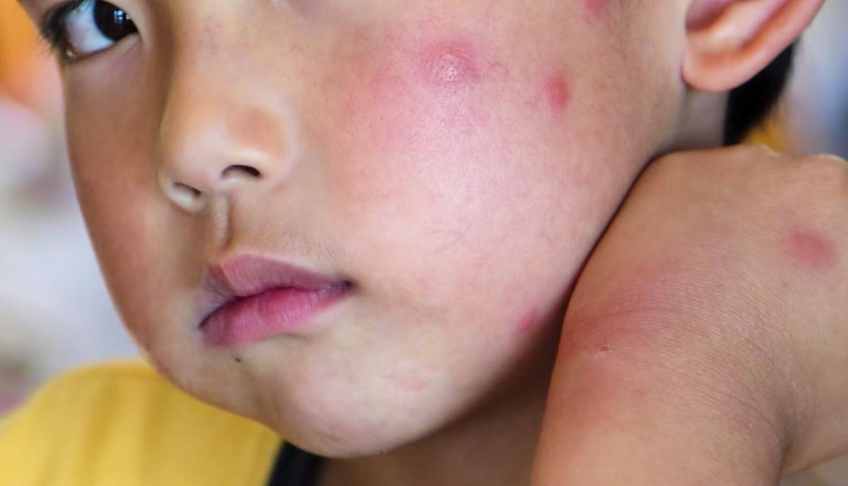 Skeeter Syndrome Mosquito Bites Can Cause Severe Reactions Health Ktbs Com
