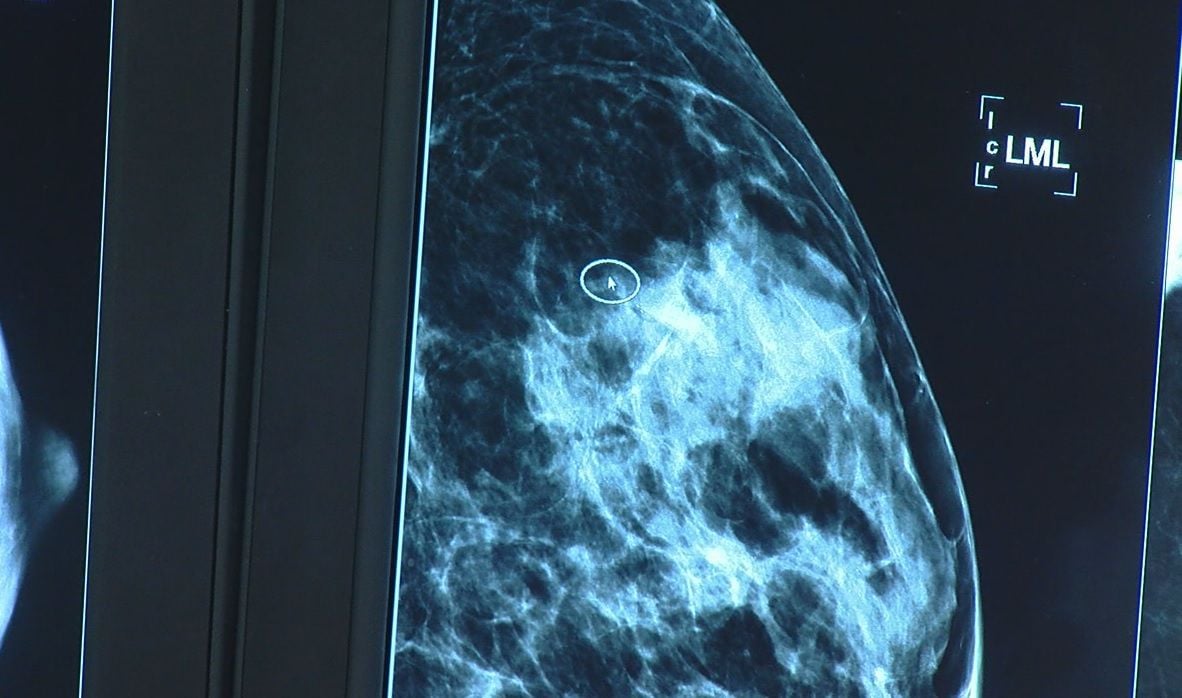 New Study Looks At Risk Association Between Body Mass Breast Cancer