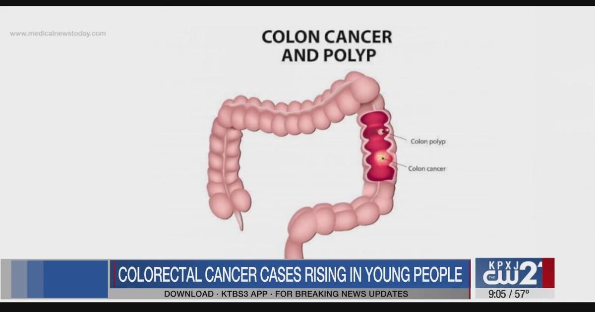 Colorectal cancer cases rising rapidly in young people | News | ktbs.com
