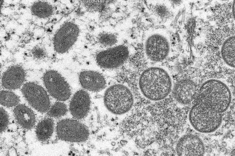 Some lab techs refuse to take blood from possible monkeypox patients, raising concerns about stigma and testing delays