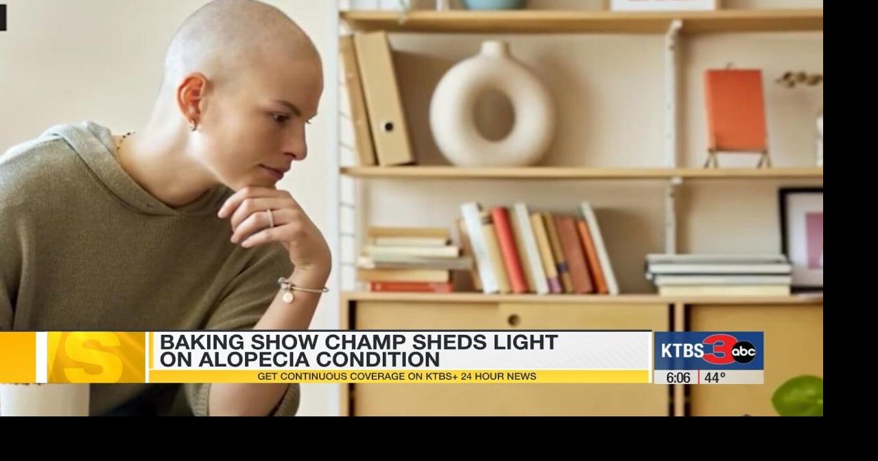 ‘Great British Baking Show’ star's platform highlights alopecia, inspires others
