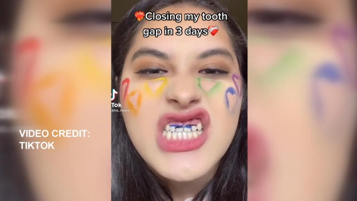 Louisiana Dental Director Speaks Out Against Tiktok Dental Hacks Entertainment Ktbs Com