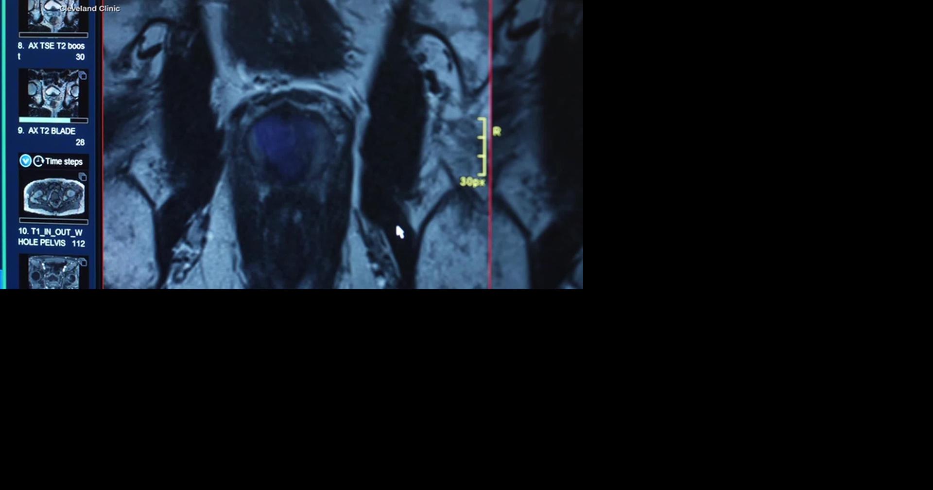 HEALTH MINUTE: NEW AI TOOL FOR PROSTATE CANCER