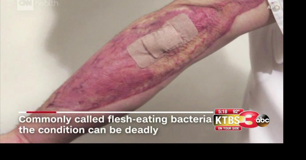 what causes flesh eating bacteria