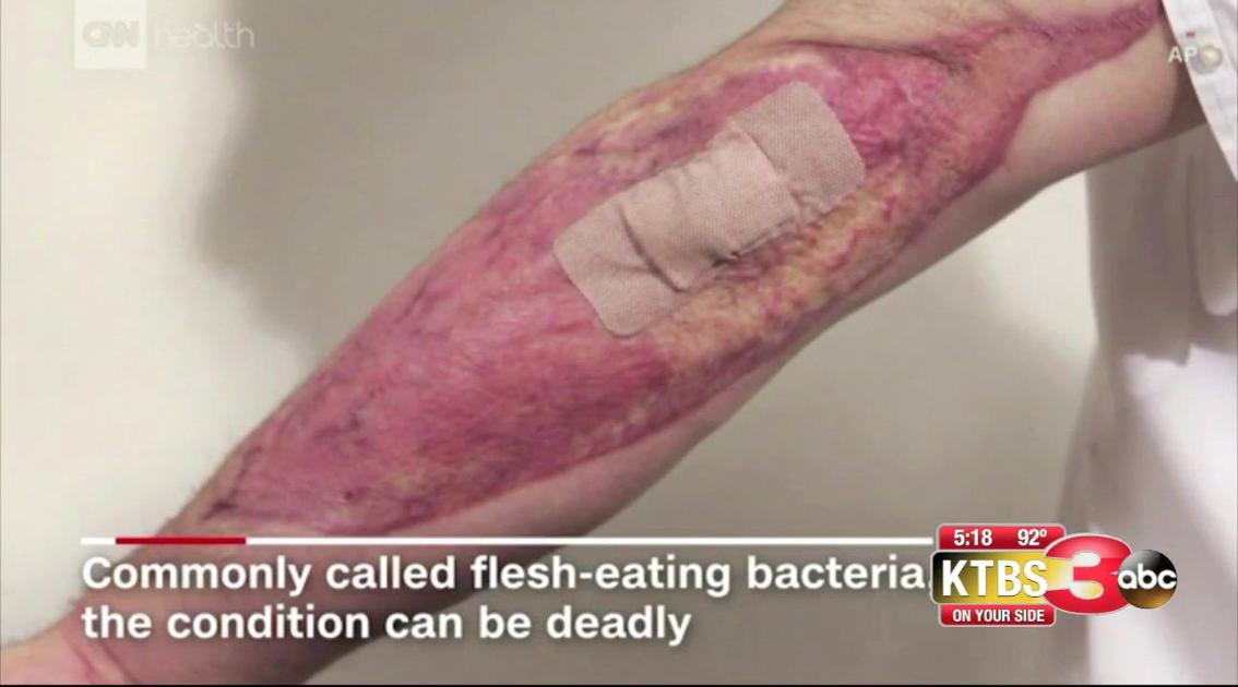 Flesh Eating Bacteria Not Only Found In Water Texarkana Ktbs Com