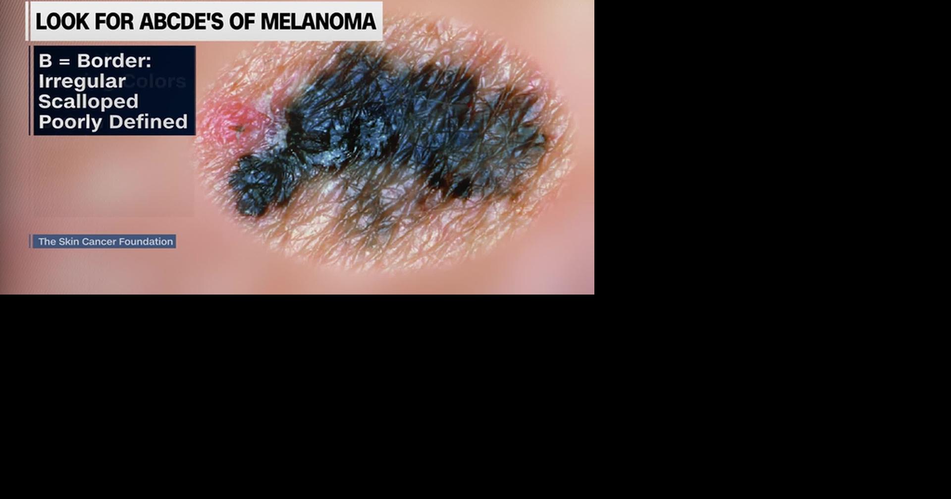 HEALTH MINUTE: WATCH FOR MELANOMA WARNING SIGNS
