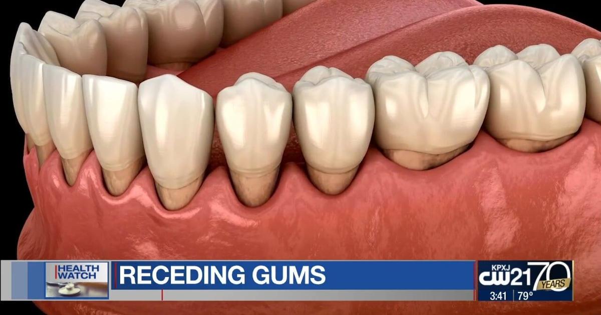 Receding gums: Causes, symptoms, and treatment options | Health | ktbs.com
