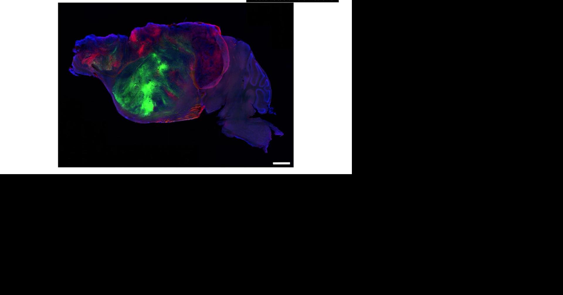 Researchers use mice with human brain cells to study Alzheimer's