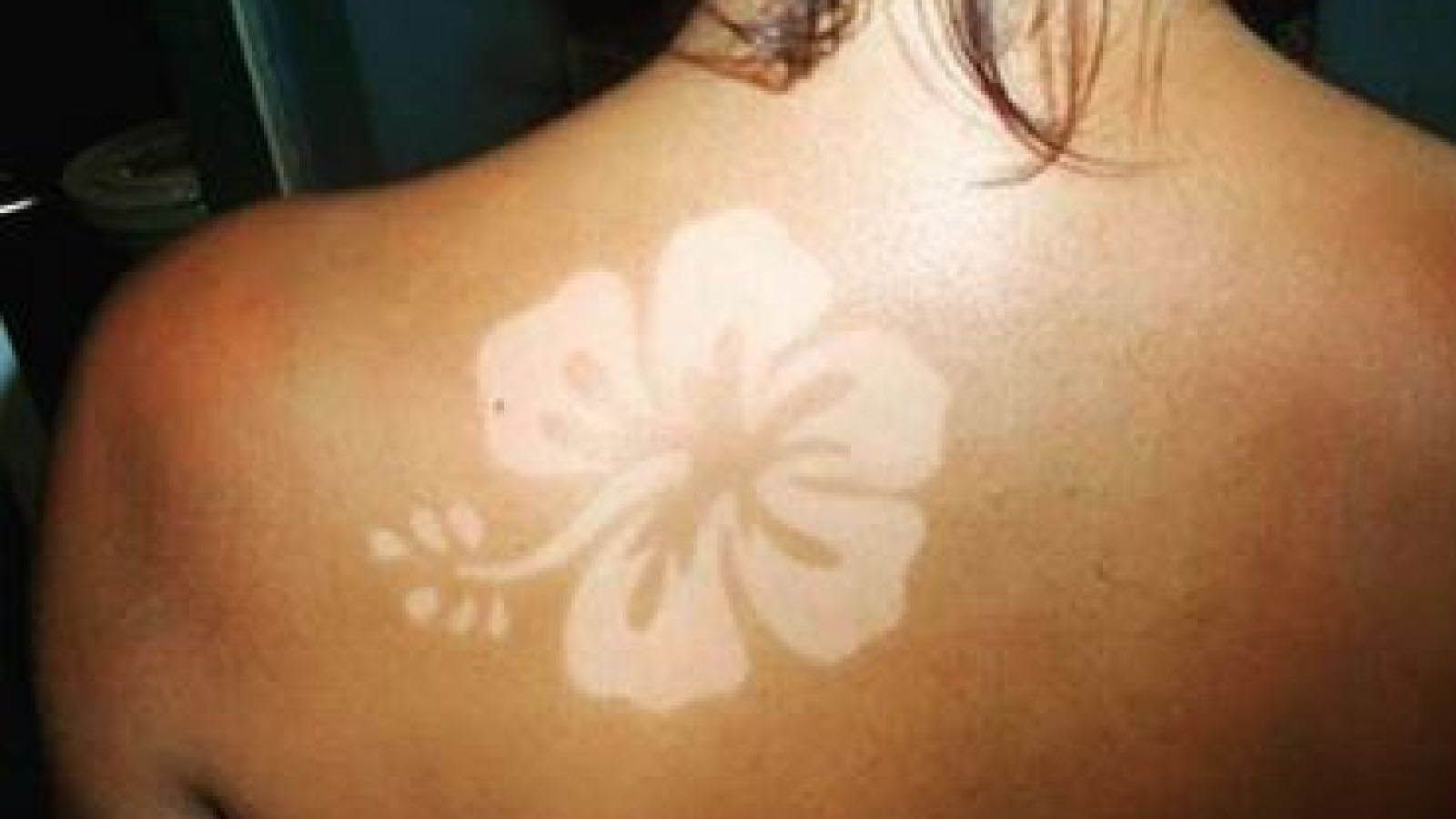 What happens to a tattoo when you get sunburned or get a lot of exposure to  sunlight in a hot climate  Quora