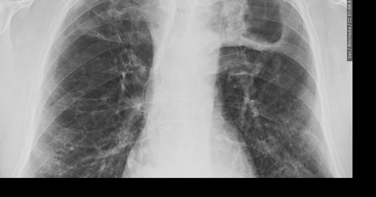 Evaluations underway after tuberculosis case found at Tucson elementary school - kvoa.com