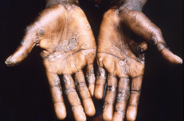 CDC's travel advisory on monkeypox 'Practice enhanced precautions