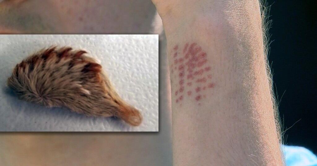 Venomous caterpillar sting sends Florida teen to hospital ...