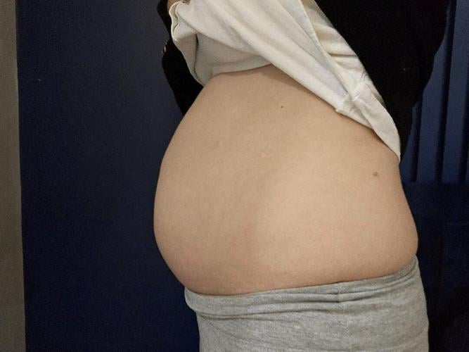 “Rare bowel disease made me look six months pregnant – doctors said it was anxiety”