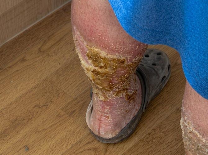 Woman died after insect bite developed into weeping wounds, despite GP visits